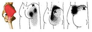 Dryneedling